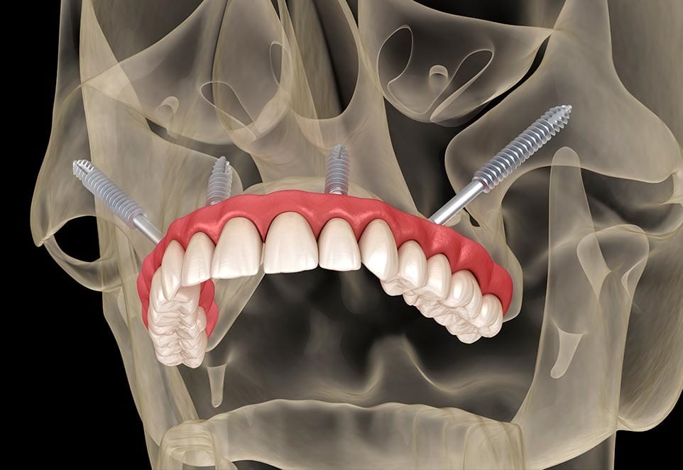 Diferencias entre implantes dentales tradicionales y cigomáticos