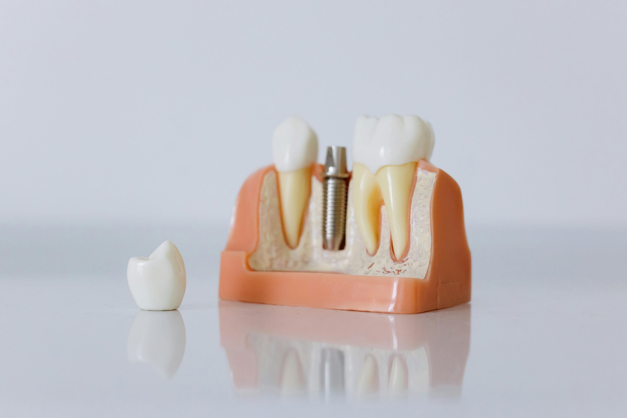 Implantes Cigomáticos en Madrid
